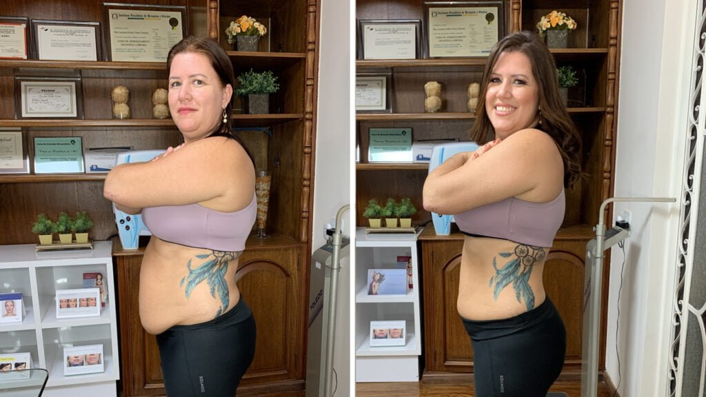 gordura localizada antes e depois