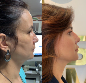 harmonização facial - antes e depois