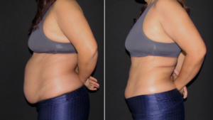 antes e depois tratamento para gordura localizada