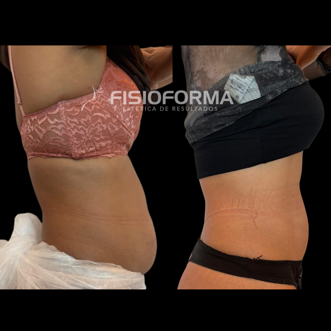 endolift - lipo a laser