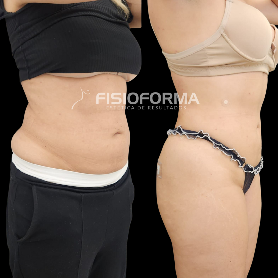 lipo a laser - endolofit - endolaser