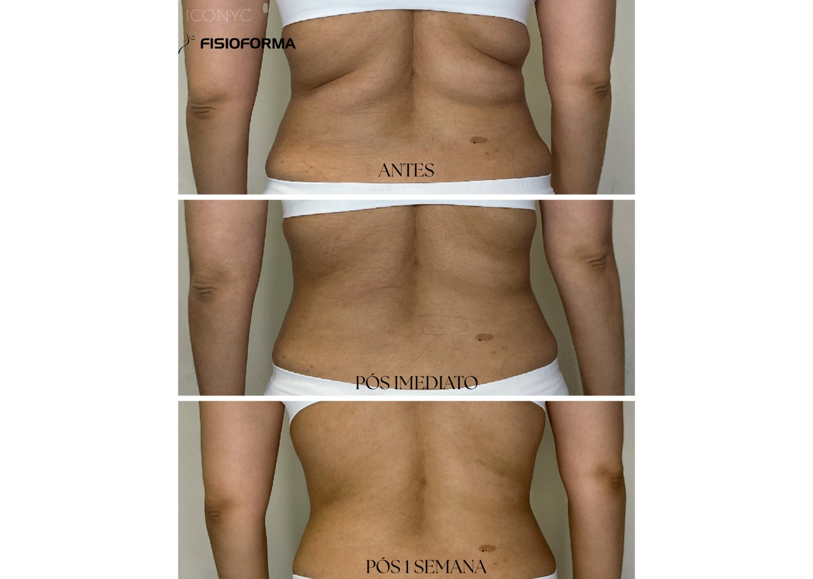 Iconyc - Tecnologia Gordura Localizada