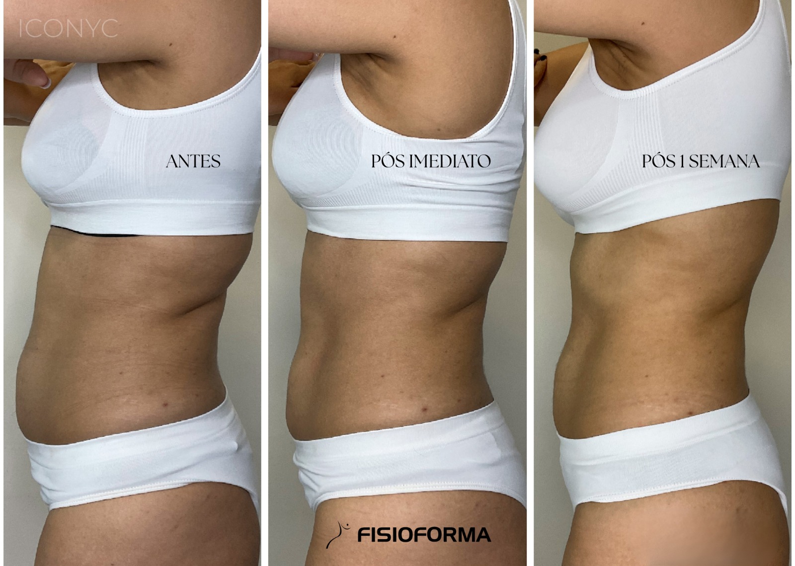 Iconyc - Gordura Localizada